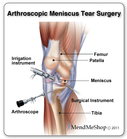 Meniscal Tear Surgery