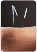 acupuncture image