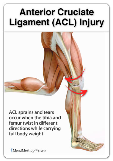 Acute ACL injuries can be caused by a sudden twist or pivot in movement.