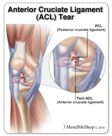 ACL (anterior cruciate ligament) tear