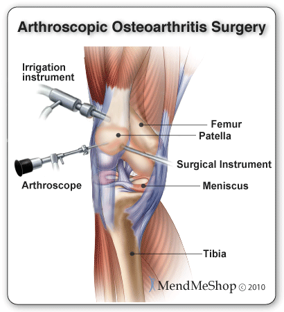 Osteoarthritis Arthroscopic Surgery