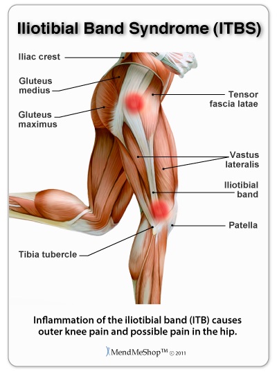 Cyclists knee pain is often caused by iliotibial band syndrome.