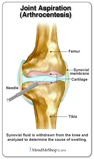 Knee joint aspiration to relieve pain.