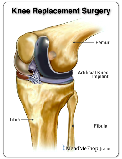 Partical knee replacement