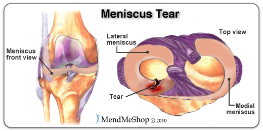 Meniscus tears can occur anywhere in the mensicus. The degree of the tear determines if surgery is necessary to suture the meniscus back together.
