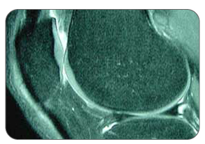 Knee MRI of osteoarthritis patient