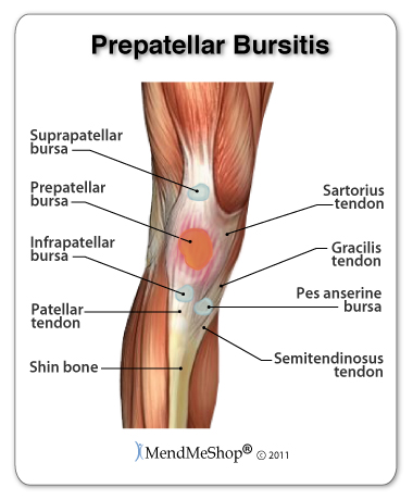 Kneeling for extended periods of time can cause patellar bursitis in the knee