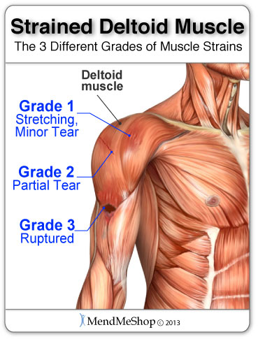 deltoid muscle strain causes shoulder pain
