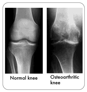 Knee X-rays normal knee and an osteoarthritic knee.