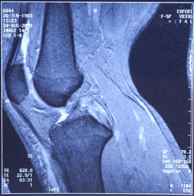 El médico analizará sus síntomas y evaluará visualmente los huesos y los tejidos blandos de la rodilla.