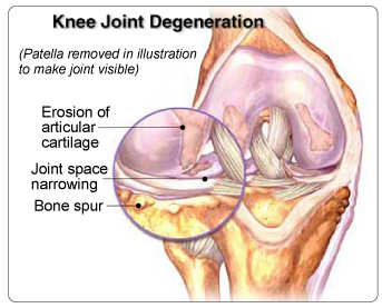 Wear and tear over time can form degenerative meniscus tear