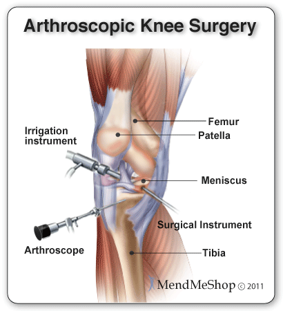 Knee surgeries are often done arthroscopically to avoid large incisions.