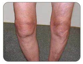 Swelling of the knee due to arthritis