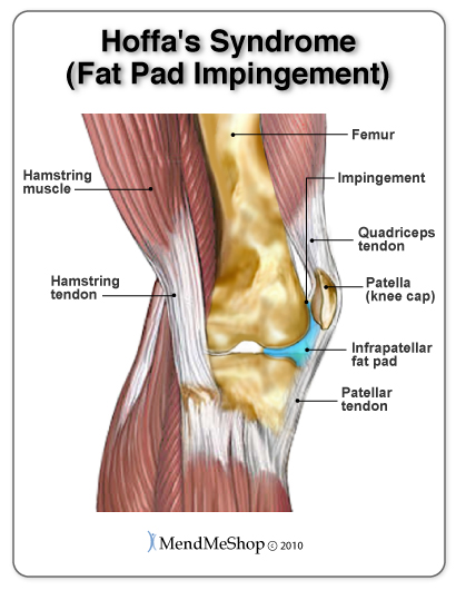 Hoffa's Syndrome causes pain in the front of the knee with swelling and inflammation under the knee cap and along the patellar tendon.
