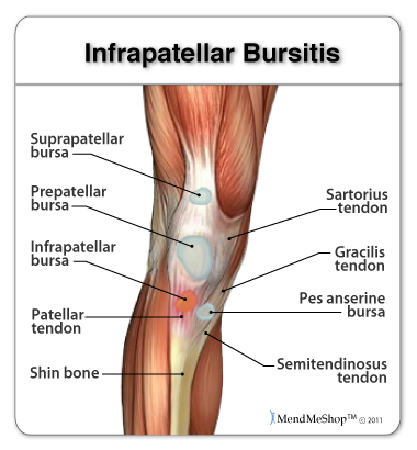 La bursite infra-patellaire provoque une douleur au genou.