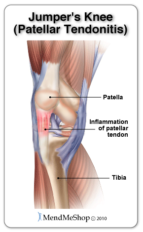 Knee joint with patellar tendinitis.