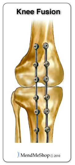 Knee fusion illustration