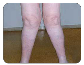 Knock-kneed joint due to osteoarthritis in the knee