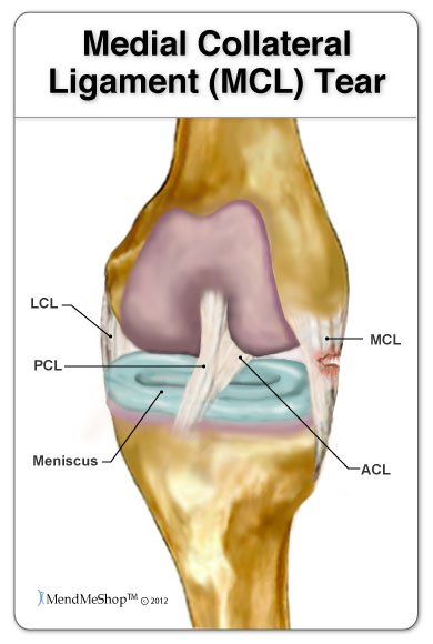 MCL - Medial Collalteral Ligament Information and Treatment