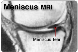 Meniscus tear image