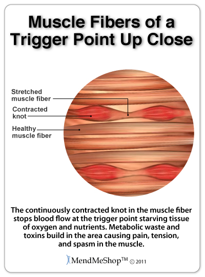 Myofascial pain trigger points cause knots in the muscle fibers resulting in tight muscle.