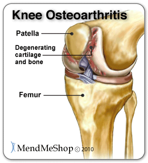 Osteoarthritis in the knee causes degeneration of the articular cartilage and bone
