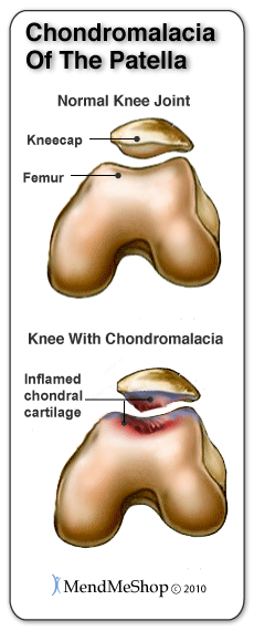 Knee joint with patellar chondromalacia