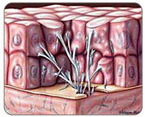 Scar tissue builds on the quadriceps tendon as the tears heal. The build up causes pain and inflexibility in the tendon making it less flexible and more prone to further injury.