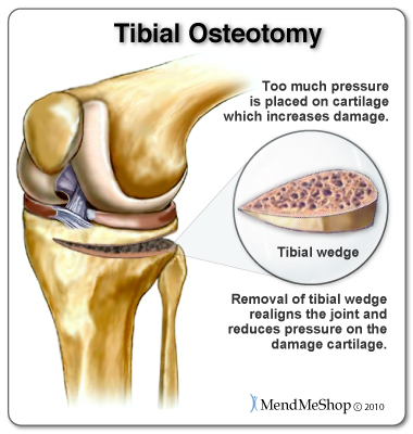 Tibial Osteotomy surgery
